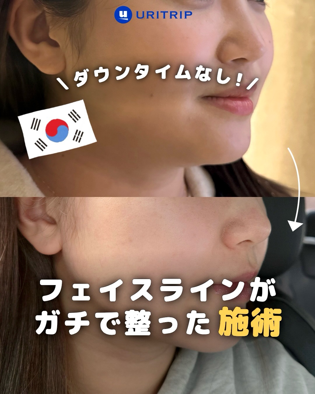 .
{フェイスラインがガチで整った施術}
韓国に行ったらやりたいことの1つが、
美容クリニックで肌